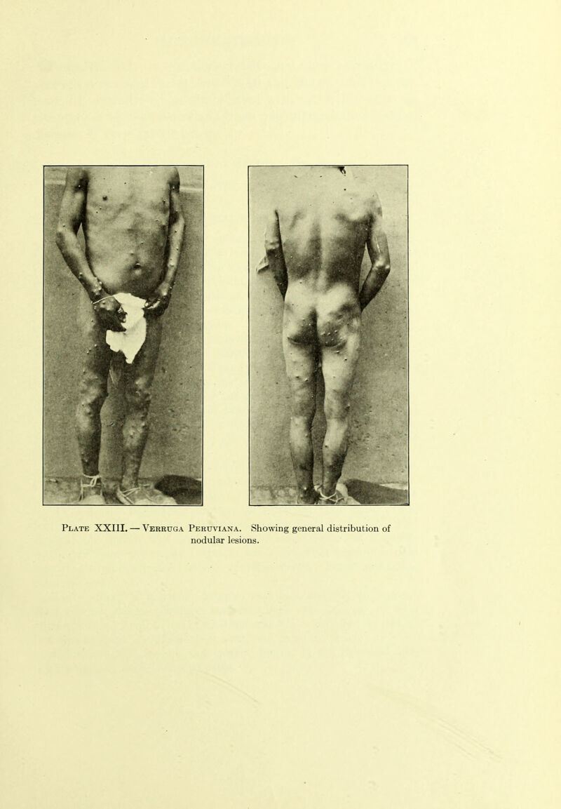 Plate XXIII. — Verruga Peruviana. Showing general distribution of nodular lesions.