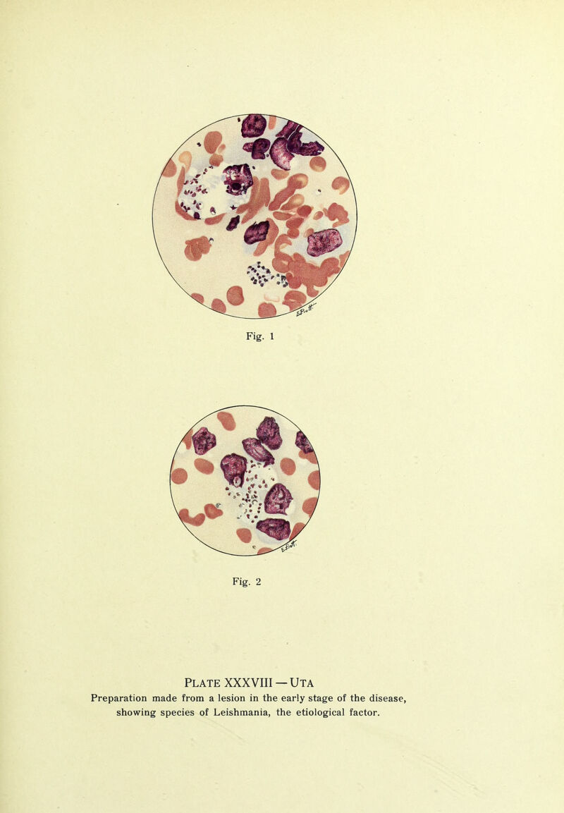 Fig. 2 Plate XXXVIII—Uta Preparation made from a lesion in the early stage of the disease, showing species of Leishmania, the etiological factor.