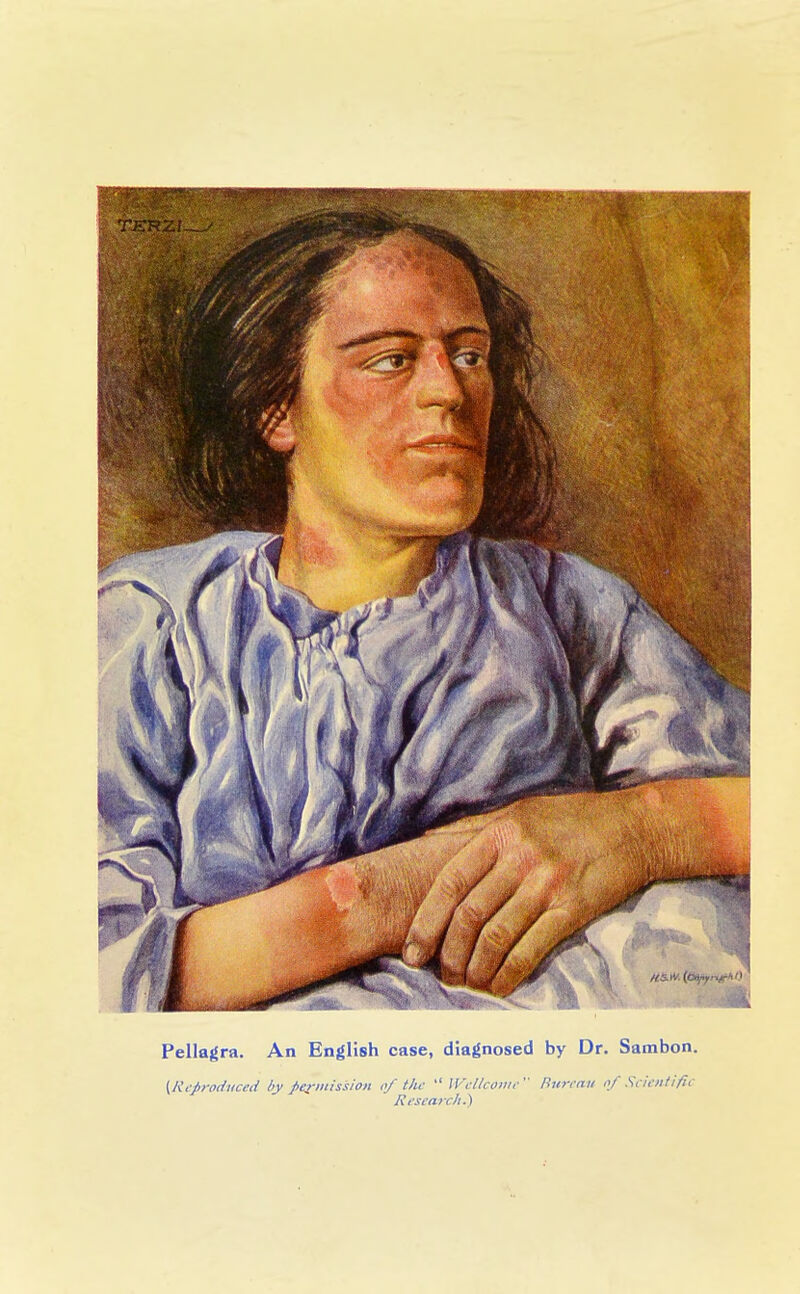 Pellagra. An English case, diagnosed by Dr. Sambon. {Reproduced by permission of tlie Wellcome Bureau of Scientific Research.)