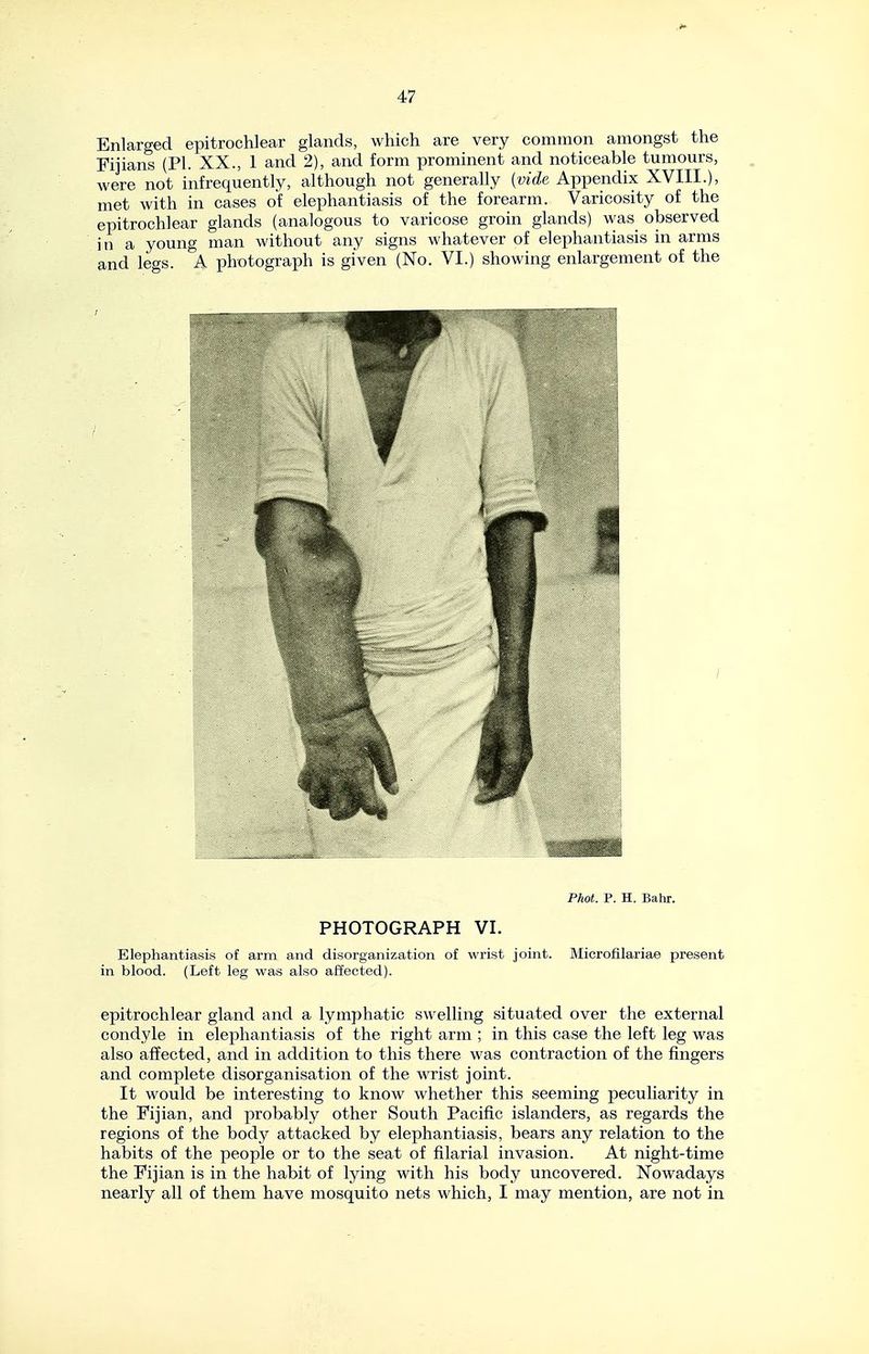 Enlarged epitrochlear glands, which are very common amongst the Fijians (PL XX., 1 and 2), and form promment and noticeable tumours, were not infrequently, although not generally {vide Appendix XVIII.), met with in cases of elephantiasis of the forearm. Varicosity of the epitrochlear glands (analogous to varicose groin glands) was_ observed in a young man without any signs whatever of elephantiasis in arms and legs. A photograph is given (No. VI.) showing enlargement of the Phot. P. H. Bahr. PHOTOGRAPH VI. Elephantiasis of arm and disorganization of wrist joint. Microfilariae present in blood. (Left leg was also affected). epitrochlear gland and a lymphatic swelling situated over the external condyle in elephantiasis of the right arm ; in this case the left leg was also affected, and in addition to this there was contraction of the fingers and complete disorganisation of the wrist joint. It would be interesting to know whether this seeming peculiarity in the Fijian, and probably other South Pacific islanders, as regards the regions of the body attacked by elephantiasis, bears any relation to the habits of the people or to the seat of filarial invasion. At night-time the Fijian is in the habit of lying with his body uncovered. Nowadays nearly all of them have mosquito nets which, I may mention, are not in