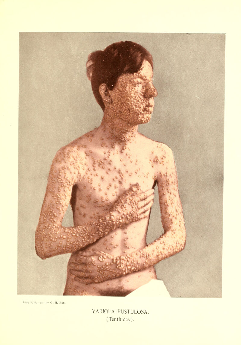 VARIOLA PUSTULOSA.