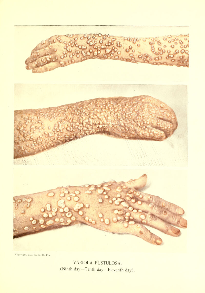 VARIOLA PUSTULOSA. (Ninth day—Tenth day—Eleventh day).