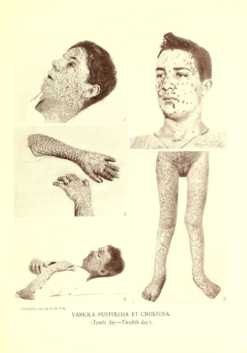 Copyright, 1902, by G. H. Fox. VARIOLA PUSTULOSA ET CRUSTOSA. (Tenth day—Twelfth day).