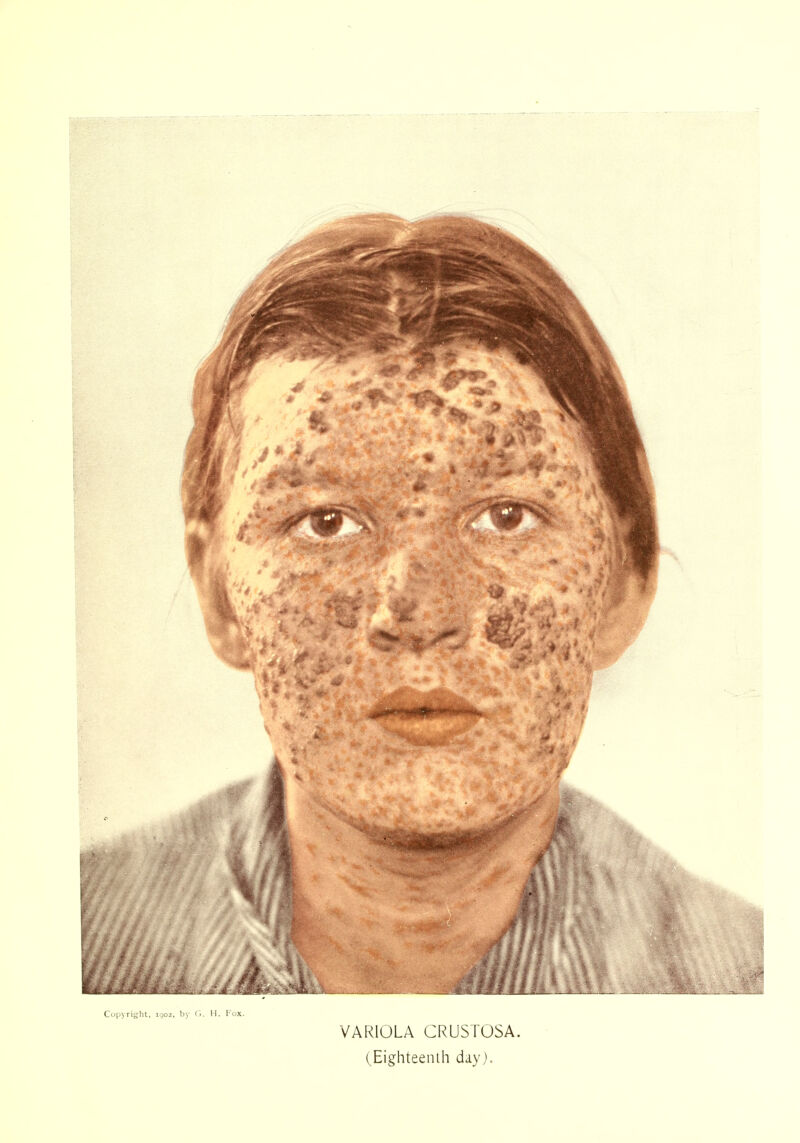 VARIOLA CRUSTOSA. (Eighteenth day).