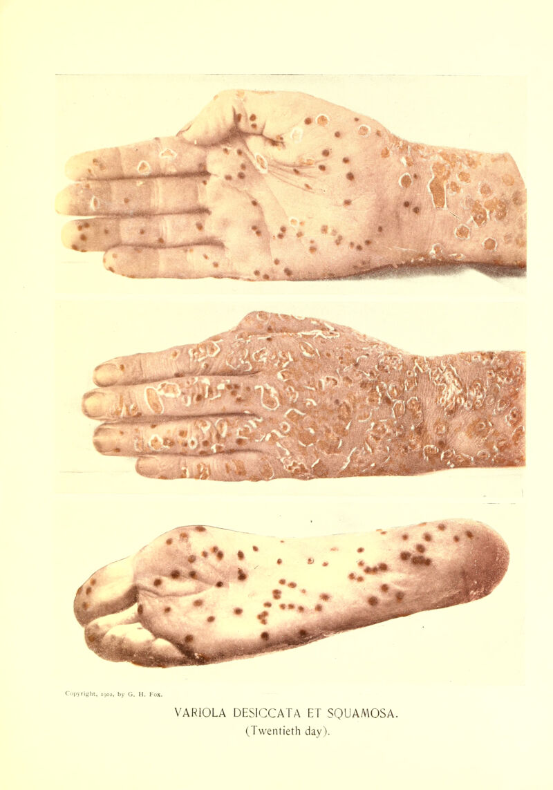 Copyright, 1902, by G. H. Fox. VARIOLA DESICCATA ET SQUAMOSA. (Twentieth day).