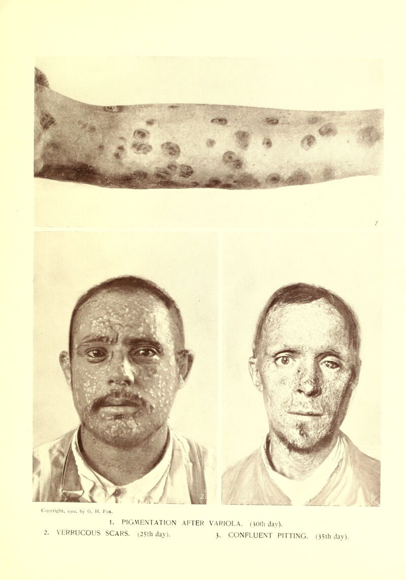 itrlu, iyo2, by G. H. Fox. 1. PIGMENTATION AFTER VARIOLA. (30(h day), VERRUCOUS SCARS. ^25th day). 3. CONFLUENT PITTING.