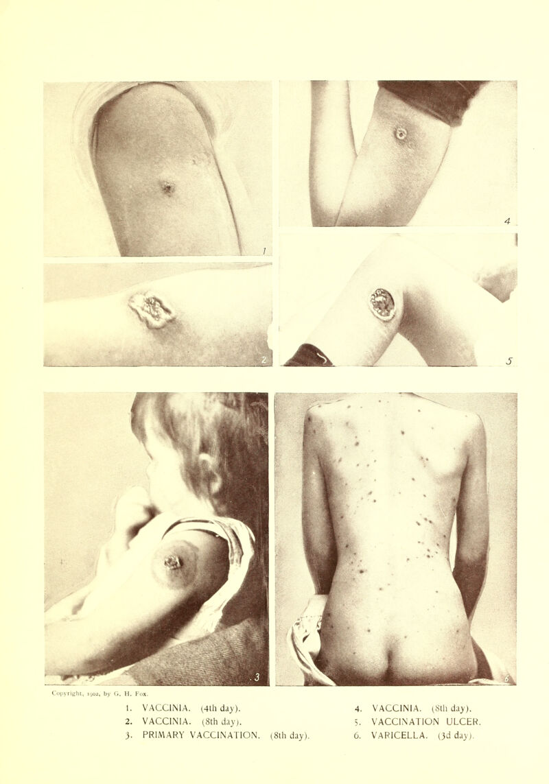 by G. H. 1-ux. 1. VACCINIA. (4th day). 2. VACCINIA. (8th day). 3. PRIMARY VACCINATION. (8lh day). 4. VACCINIA. (Sth day). 5. VACCINATION ULCER 6. VARICELLA. (3d day).