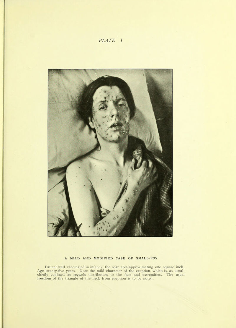 A MILD AND MODIFIED CASE OF SMALL-POX Patient well vaccinated in infancy, the scar area approximating one square inch. Age twentv-five years. Note the mild character of the eruption, which is, as usual, chiefly confined as regards distribution to the face and extremities. The usual freedom of the triangle of the neck from eruption is to be noted.