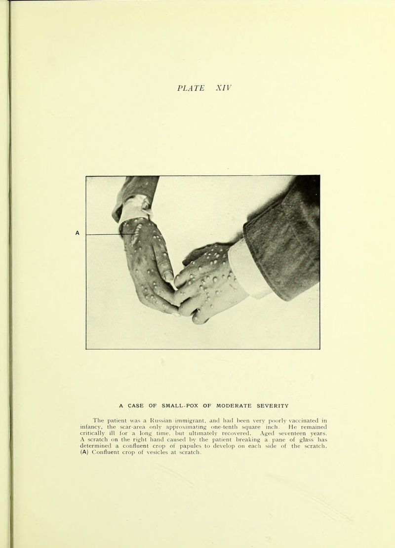 A A CASE OF SMALL- POX OF MODERATE SEVERITY The patient was a Russian immigrant, and had been very poorly vaccinated in infancy, the scar-area only approximating one-tenth square inch. He remained critically ill for a long time, but ultimately recovered. Aged seventeen years. A scratch on the right hand caused by the patient breaking a pane of glass has determined a confluent crop of papules to develop on each side of the scratch. (A) Confluent crop of vesicles at scratch.