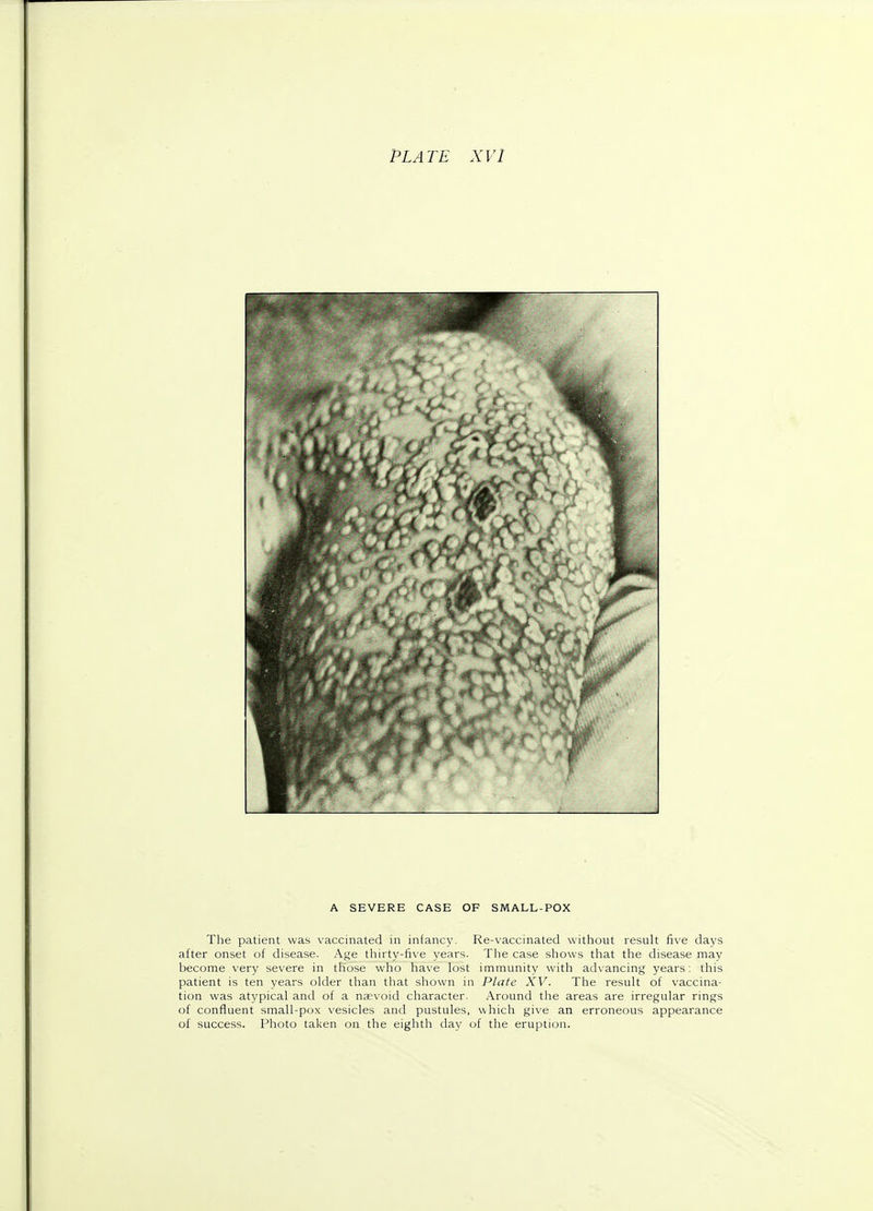 A SEVERE CASE OF SMALL-POX The patient was vaccinated in infancy. Re-vaccinated without result five days after onset of disease. Age thirty-five years. The case shows that the disease may become very severe in those who have lost immunity with advancing years: this patient is ten years older than that shown in Plate XV. The result of vaccina- tion was atypical and of a naevoid character. Around the areas are irregular rings of confluent small-pox vesicles and pustules, which give an erroneous appearance of success. Photo taken on the eighth day of the eruption.