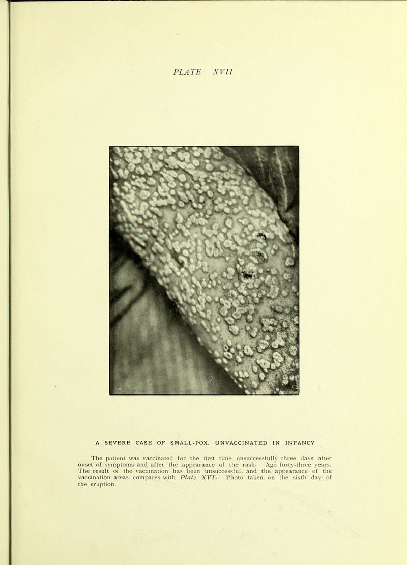 A SEVERE CASE OF SMALL-POX, UNVACCINATED IN INFANCY The patient was vaccinated for the first time unsuccessfully three days after onset of symptoms and after the appearance of the rash. Age forty-three years. The result of the vaccination has been unsuccessful, and the appearance of the vaccination areas compares with Plate XVI. Photo taken on the sixth day1 of the eruption.