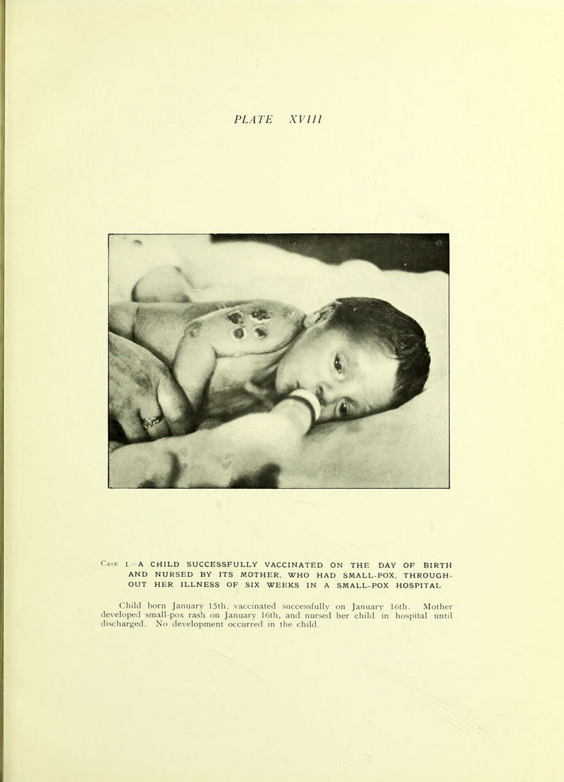 PLATE XV111 Case l.—a CHILD SUCCESSFULLY VACCINATED ON THE DAY OF BIRTH AND NURSED BY ITS MOTHER, WHO HAD SMALL-POX, THROUGH- OUT HER ILLNESS OF SIX WEEKS IN A SMALL-POX HOSPITAL Child born January 15th, vaccinated successfully on January 16th. Mother developed small-pox rash on January 16th, and nursed her child in hospital until discharged. No development occurred in the child.