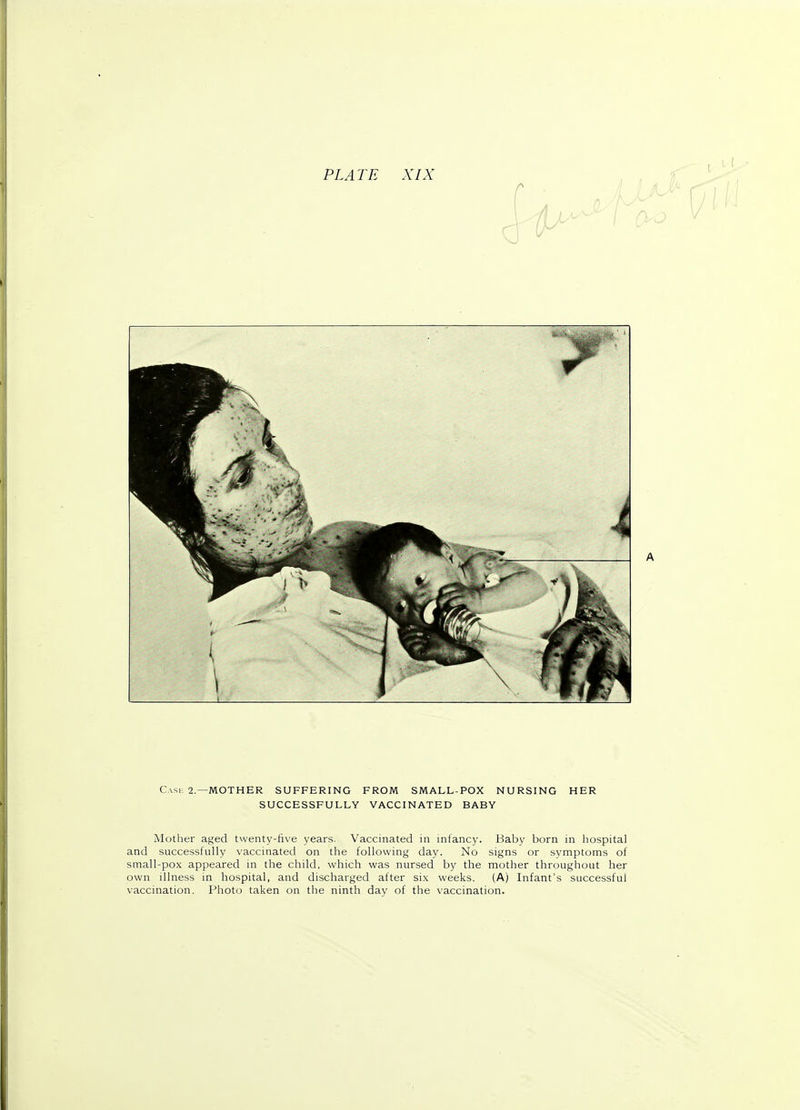 Case 2.—MOTHER SUFFERING FROM SMALL-POX NURSING HER SUCCESSFULLY VACCINATED BABY Mother aged twenty-five years. Vaccinated in infancy. Baby born in hospital and successfully vaccinated on the following day. No signs or symptoms of small-pox appeared in the child, which was nursed by the mother throughout her own illness in hospital, and discharged after six weeks. (A) Infant's successful vaccination. Photo taken on the ninth dav of the vaccination.