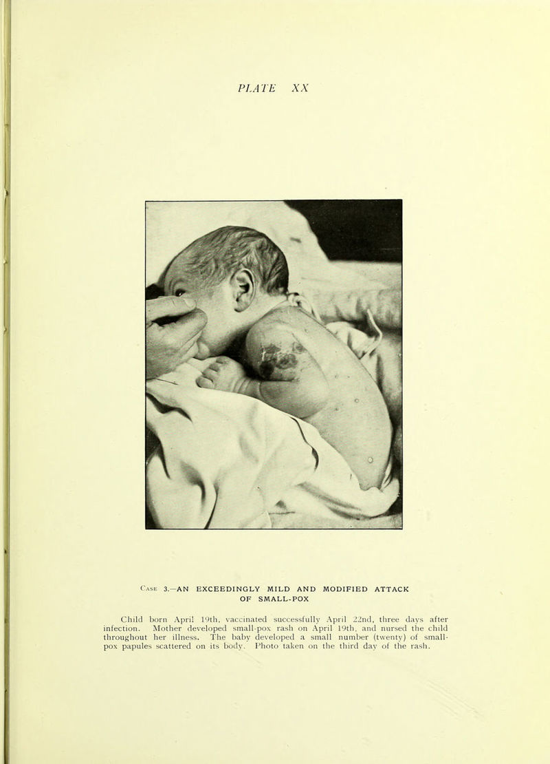 PLATE XX Case 3—AN EXCEEDINGLY MILD AND MODIFIED ATTACK OF SMALL-POX Child born April 19th, vaccinated successfully April 22nd, three days after infection. Mother developed small-pox rash on April 19th, and nursed the child throughout her illness. The baby developed a small number (twenty) of small- pox papules scattered on its body. Photo taken on the third day of the rash.