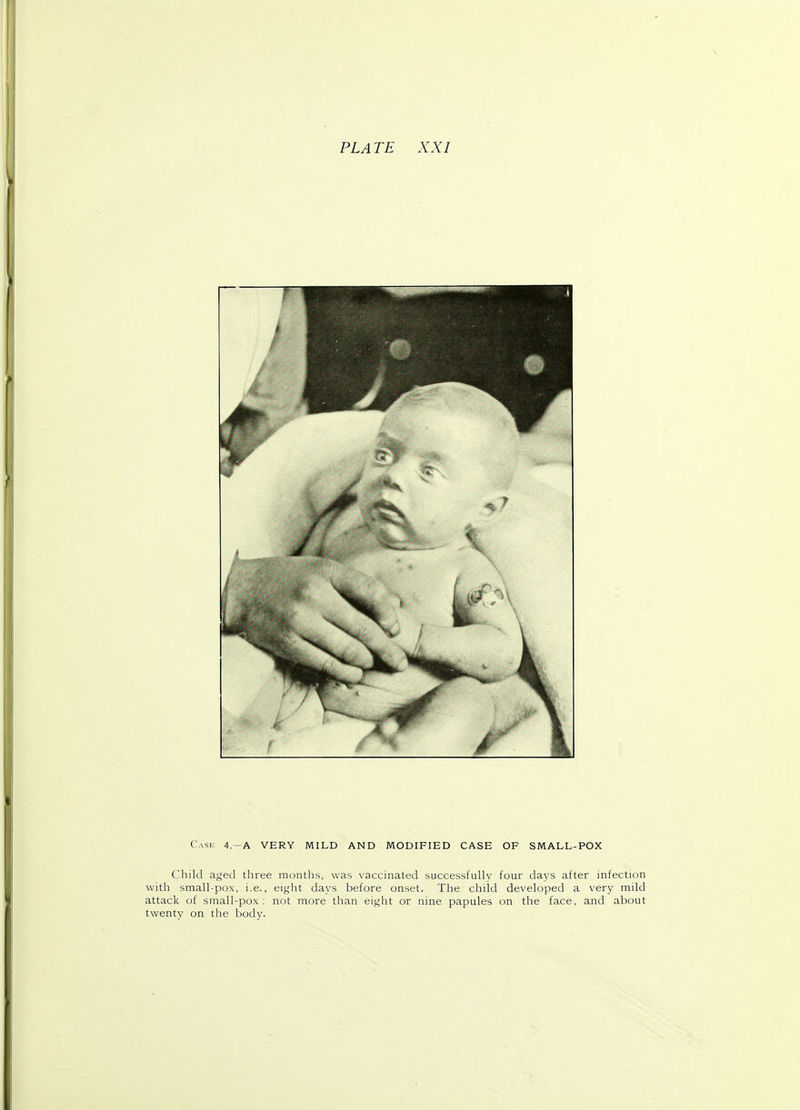 Case 4.—A VERY MILD AND MODIFIED CASE OF SMALL-POX Child aged three months, was vaccinated successfully four days after infection with small-pox, i.e., eight days before onset. The child developed a very mild attack of small-pox: not more than eight or nine papules on the face, and about twenty on the body.