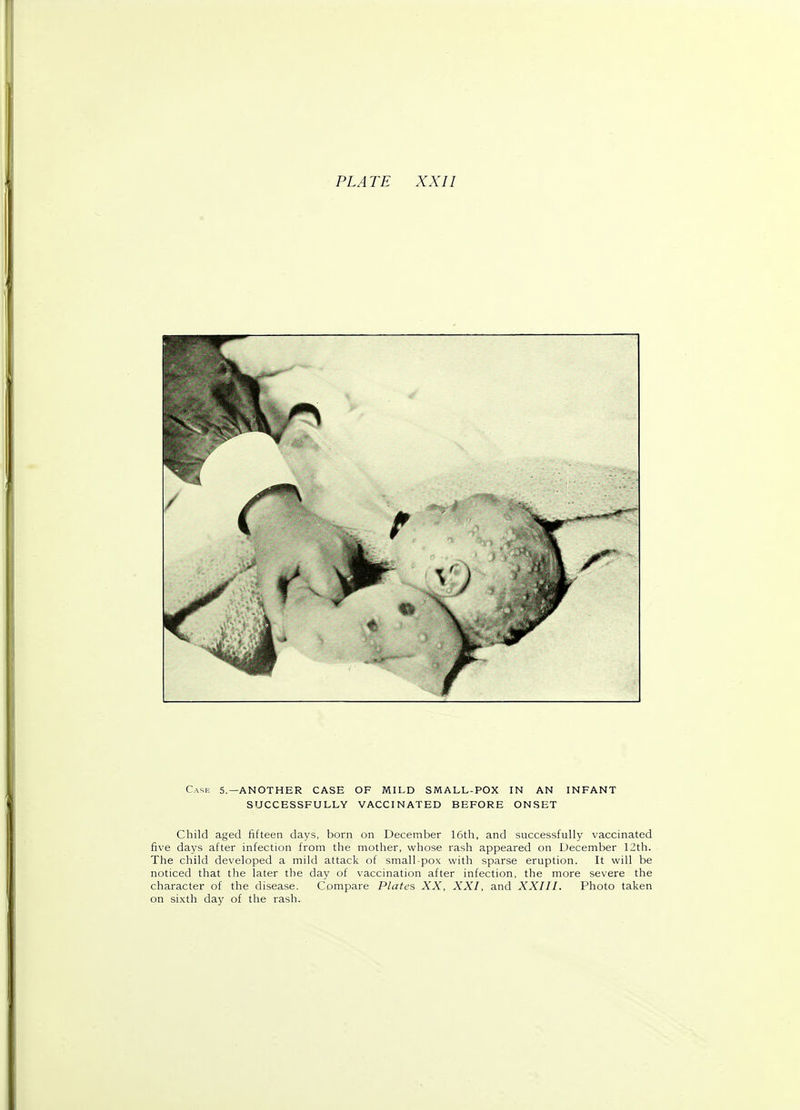 Case 5.—ANOTHER CASE OF MILD SMALL-POX IN AN INFANT SUCCESSFULLY VACCINATED BEFORE ONSET Child aged fifteen days, born on December 16th, and successfully vaccinated five days after infection from the mother, whose rash appeared on December 12th. The child developed a mild attack of small-pox with sparse eruption. It will be noticed that the later the day of vaccination after infection, the more severe the character of the disease. Compare Plates XX, XXI, and XXIII. Photo taken on sixth day of the rash.