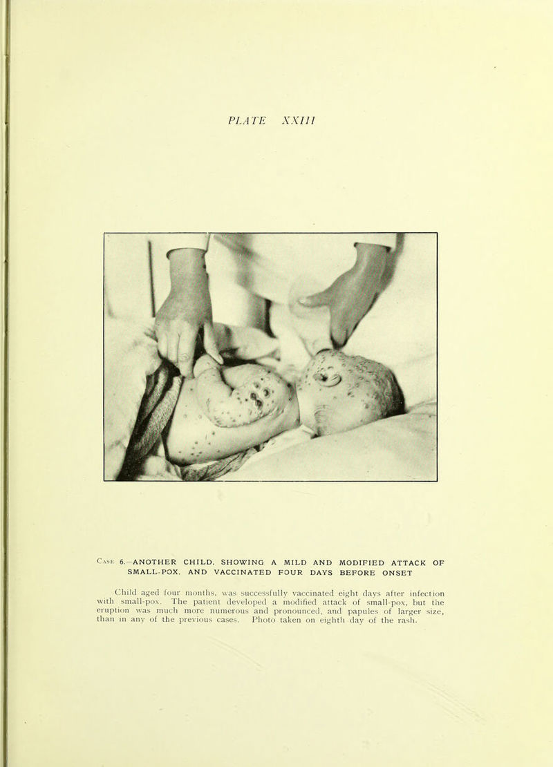 Case 6.—ANOTHER CHILD, SHOWING A MILD AND MODIFIED ATTACK OF SMALL-POX, AND VACCINATED FOUR DAYS BEFORE ONSET Child aged four months, was successfully vaccinated eight days after infection with small-pox. The patient developed a modified attack of small-pox, but the eruption was much more numerous and pronounced, and papules of larger size, than in any of the previous cases. Photo taken on eighth day of the rash.