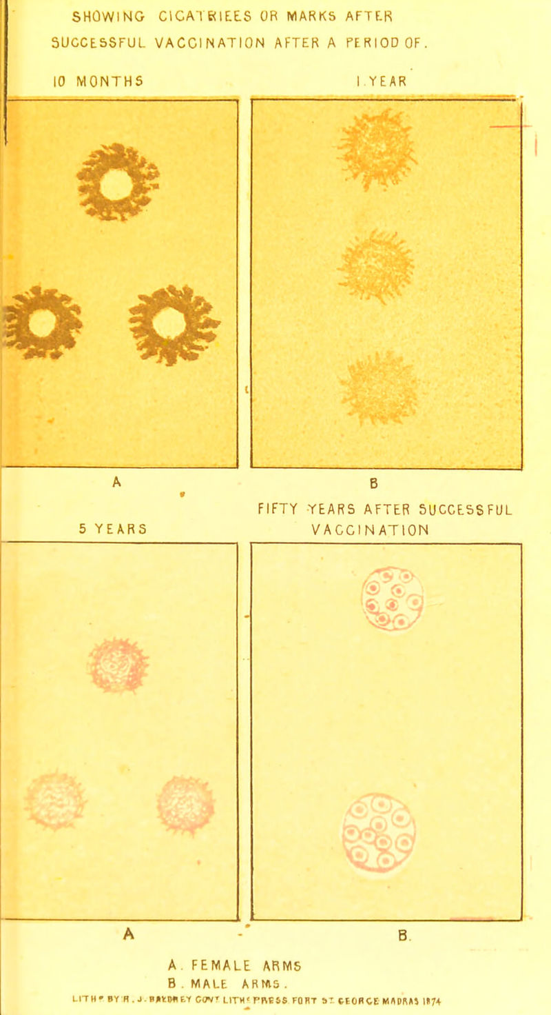SHOWING CICATRIXES OR MARKS AFTER SUCCESSFUL VACCINATION AFTER A PERIOD OF 10 MONTHS YEAR 5 YEARS FIFTY YEARS AFTER SUCCESSFUL VACCINATION A. FEMALE ARMS B . MALE ARIAS . LI-TH* BY R. J inira CW LITH' PRESS FORT s? C-iORCE MflBRHi l«74