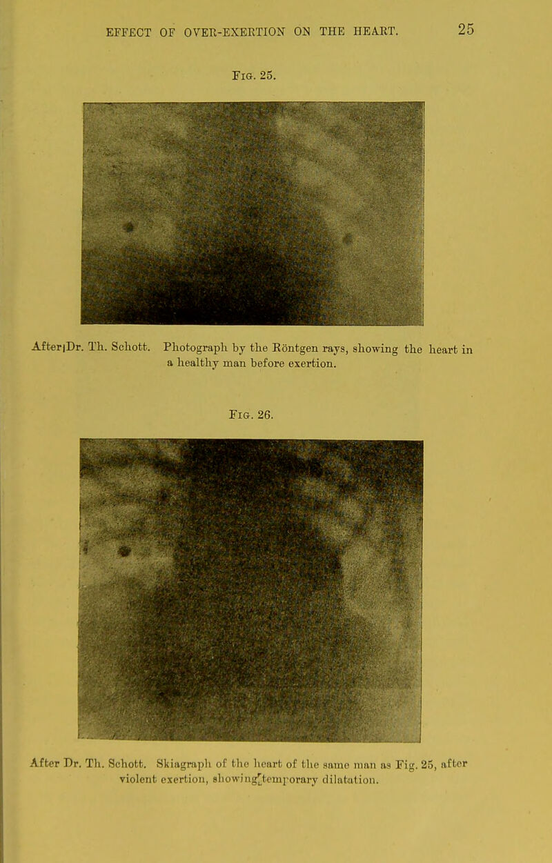 AfteriDr. Tli. Scliott. Photograph by the Rontgen rays, showing the heart in a healthy man before exertion. Fig. 26. After Dr. Th. Schott. Skiagraph of the heart of the same man as Fig. 25, after violent exertion, ahowingJItemi'orary dilatation.