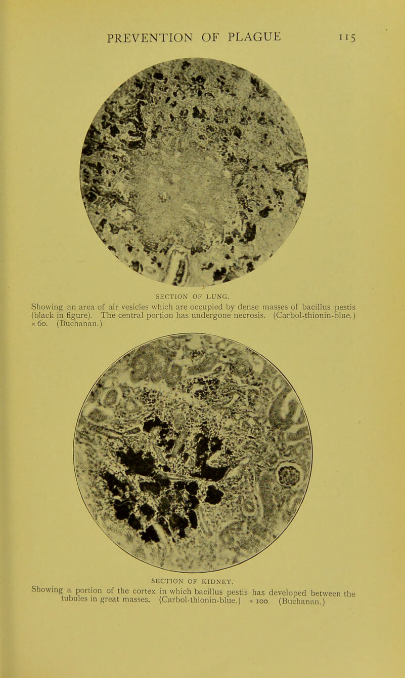 SECTION OF LUNG. Showing an area of air vesicles which are occupied by dense masses of bacillus pestis (black in figure). The central portion has undergone necrosis. (Carbol-thionin-blue.) X 60. (Buchanan.) SEC'I'lON OF KIDNEY. Showing a portion of the cortex in which bacillus pestis has developed between the tubules in great masses. (Carbol-thionin-blue.) x 100. (Buchanfin.)