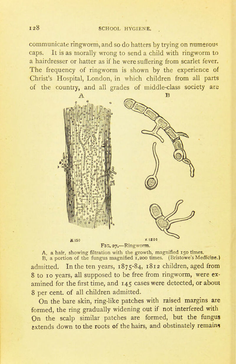 communicate ringworm, and so do hatters by trying on numerou«: caps. It is as morally wrong to send a child with ringworm to a hairdresser or hatter as if he were suffering from scarlet fever. The frequency of ringworm is shown by the experience of Christ's Hospital, London, in which children from all parts of the country, and all grades of middle-class society art' A B Fig. 27.—Ringworm. A, a hair, showing filtration with the growth, magnified 150 times. B, a portion of the fungus magnified 1,200 times. (Bristowe's Medicine,) admitted. In the ten years, 1875-84, 1812 children, aged from 8 to 10 years, all supposed to be free from ringworm, were ex- amined for the first time, and 145 cases were detected, or about 8 per cent, of all children admitted. On the bare skin, ring-like patches with raised margins are formed, the ring gradually widening out if not interfered with On the scalp similar patches are formed, but the fungus extends down to the roots of the hairs, and obstinately remaim