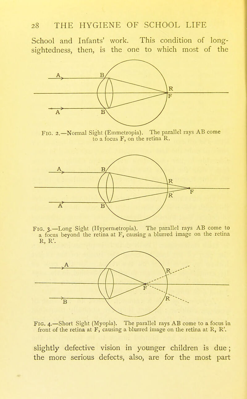 School and Infants' work. This condition of long- sightedness, then, is the one to which most of the B/ V 'f Fig. 2.—Normal Sight (Emmetropia). The parallel rays AB come to a focus F, on the retina R. > '4 ilR r> Fig. 3.—Long Sight (Hypernietropia). The parallel rays AB come to a focus beyond the retina at F, causing a blurred image on the retina R, R'. > Fig. 4.—Short Sight (Myopia). The parallel rays AB come to a focus in front of the retina at F, causing a blurred image on the retina at R, R'. slightly defective vision in younger children is due; the more serious defects, also, are for the most part