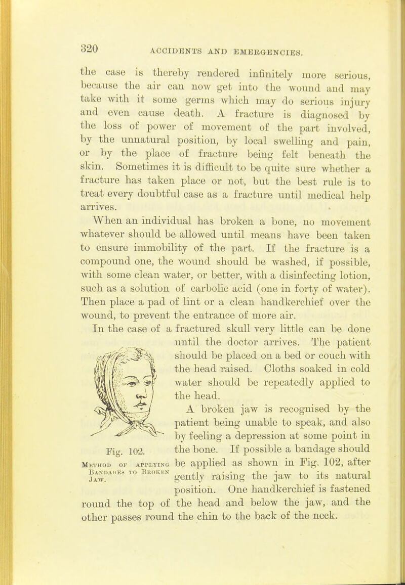the case is thereby reudered infinitely more serious, because the air can now get into the wound and may talce with it some germs which may do serious injury and even cause death. A fracture is diagnosed by the loss of power of movement of the part involved, by the unnatural position, by local swelUug and pain, or by the place of fracture being felt beneath the skin. Sometimes it is difficult to be quite sure whether a fracture has taken place or not, but the best rule is to treat every doubtful case as a fracture until medical help arrives. When an individual has broken a bone, no movement whatever should be allowed until means have been taken to ensure immobility of the part. If the fractiire is a compound one, the wound should be washed, if possible, with some clean water, or better, with a disinfecting lotion, such as a solution of carbolic acid (one in forty of water). Then place a pad of lint or a clean handkerchief over the wound, to prevent the entrance of more air. In the case of a fractiired skull very little can be done until the doctor arrives. The patient should be placed on a bed or couch with the head raised. Cloths soaked in cold water should be repeatedly applied to the head. A broken jaw is recognised by the patient being unable to speak, and also by feeling a depression at some point in Fig. 102. the bone. If possible a bandage should Method of applying be applied as showu in Fig. 102, after ban.,a.;es to Brok.cn ^^^^^^ raising the jaw to its natural position. One handkerchief is fastened round the top of the head and below the jaw, and the other passes round the chin to the back of the neck.