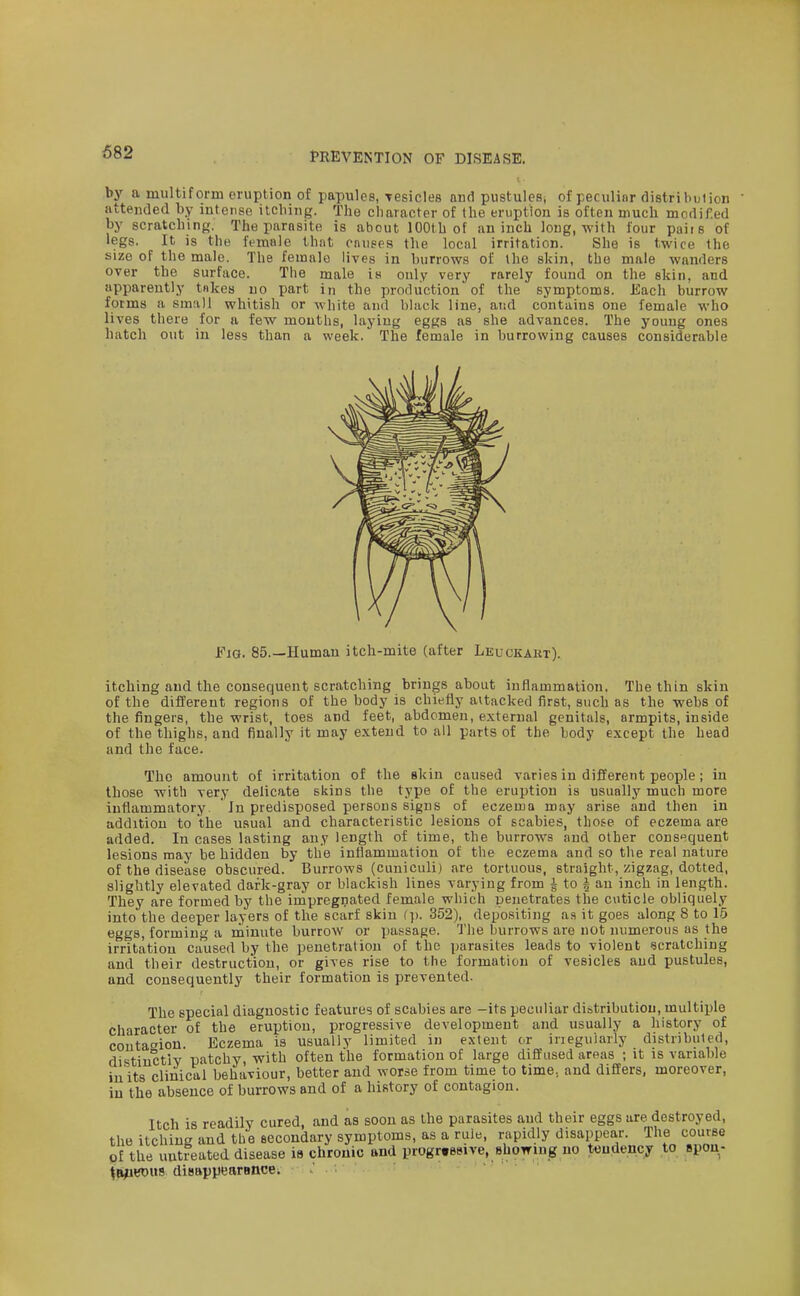 682 by a multiform eruption of papules, -resides and pustulesj of peculiar distribuiion attended by intense itching. The character of the eruption is often much modif.ed by scratching. The parasite is abcut 100th of an inch Jong, with four paiis of legs. It is the female that oniiges the local irritation. She is twice the size of the male. The female lives in burrows of the skin, the male wanders over the surface. The male is only very rarely found on the skin, and apparently tnkes no part in the production of the symptoms. Each burrow forms a small whitish or white and black line, and contains one female who lives there for a few mouths, laying eggs as she advances. The young ones hatch out in less than a week. The female in burrowing causes considerable Fig. 85.—Human itch-mite (after Leuckart). itching and the consequent scratching brings about inflammation. The thin skin of the different regions of the body is chiefly attacked first, such as the webs of the fingers, the wrist, toes and feet, abdomen, external genitals, armpits, inside of the thighs, and finally it may extend to all parts of the body except the head and the face. The amount of irritation of the skin caused varies in different people; in those with very delicate skins the type of the eruption is usually much more inflammatory. ' In predisposed persons signs of eczema may arise and then in addition to the usual and characteristic lesions of scabies, those of eczema are added. In cases lasting any length of time, the burrows and other cons'^quent lesions may be hidden by the inflammation of the eczema and so tlie real nature of the disease obscured. Burrows (ciiniculi) are tortuous, straight, zigzag, dotted, slightly elevated dark-gray or blackish lines varying from J to | an inch in length. They are formed by the impregnated female which penetrates the cuticle obliquely into the deeper layers of the scarf skin (]). 352), depositing aa it goes along 8 to 15 eggs, forming a minute burrow or passage. The burrows are not numerous as the irritation caused by the ])enetiatiou of the parasites leads to violent scratching and their destruction, or gives rise to the formation of vesicles and pustules, and consequently their formation is prevented. The special diagnostic features of scabies are -its peculiar distribution, multiple character of the eruption, progressive development and usually a history of coutaoion. Eczema is usually limited in extent cr irieguiarly distributed, distinctly patchy, with often the formation of large diffused areas ; it is variable in its clinical behaviour, better and worse from time to time, and differs, moreover, in the absence of burrows and of a history of contagion. Itch is readily cured, and as soon as the parasites and their eggs are destroyed, the itching and the eecoudary symptoms, as a rule, rapidly disappear. The course of the untreated disease is chronic and progressive, showing no tendency to spoa- ^RpBDits disappearBUce.