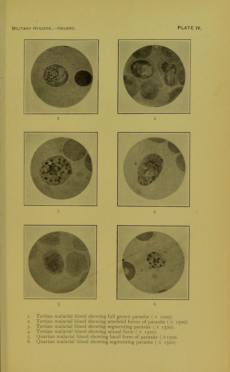 1. Tertian malarial blood showing full grown parasite ( X looo). 2. Tertian malarial blood showing ameboid forms of parasite ( X 1500) 3. Tertian malarial blood showing segmenting parasite ( X 1500). 4. Tertian malarial tilood showing sexual form (x 1500). 5. Quartan malarial blood showing band form of jjarasitc ( XT500. 6. Quartan malarial blood showing segmenting parasite ( X 1500)