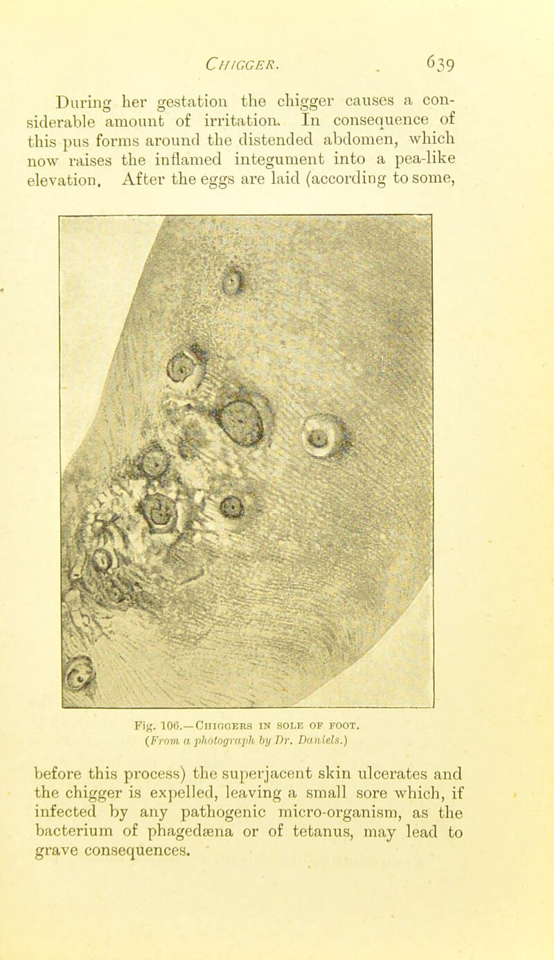 CffiCGER. During her gestation tlie chigger causes a con- siderable amount of irritation. In consequence of this pus forms around the distended abdomen, which now raises the inflamed integument into a pea-like elevation. After the eggs are laid (according to some, Fig. 106.—CniaoERs in sole of foot. {From a photorjraiih by Dr. Daniels.) before this process) the superjacent skin ulcerates and the chigger is expelled, leaving a small sore which, if infected by any pathogenic micro-organism, as the bacterium of phagedjena or of tetanus, may lead to grave consequences.