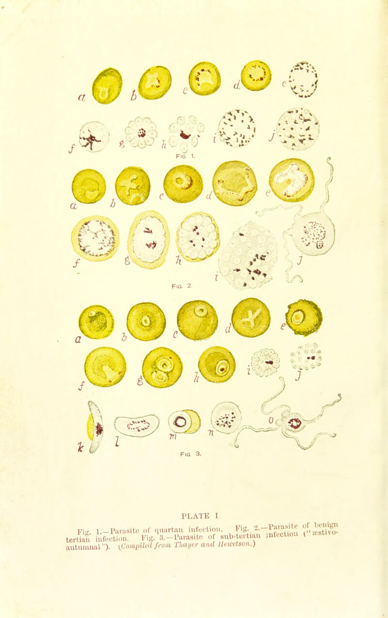 PLATE I Fi.r 1-Parasite o( quartan infection. Fig. •^■-^^f^^i^ '^-^^ tertilS; inr,.,-tion. Fig. 3.-l'arasitn of snb-tertian nifecfou i .v.tno autumnal )• [^Cominkd from, Thayer and llcu-ctsoii.)