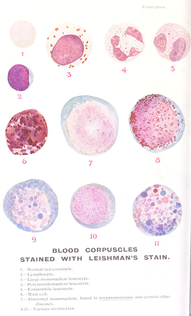 Frond^piftf. 1. —Normal red corpuscle. 2. —Ly mphocyte. —Larjie mononuclear leucocyte. 4. —Polymorphonuclear leucocyte. 5. —Kosinophile leucocyte. H.—Mast cell. 7.-Ahnm-m:il monomiclcar, fmiTUi in to panosqmiasis and certain other diseases. S-11.—Various myelocytes. BLOOD CORPUSCLES STAINED WITH LEISHMAN’S STAIN.