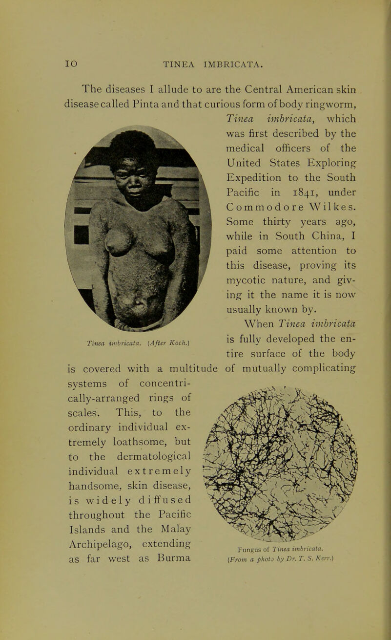 lO TINEA IMBRICATA. The diseases I allude to are the Central American skin disease called Pinta and that curious form of body ringworm, Tinea imbricata, which was first described by the medical officers of the United States Exploring Expedition to the South Pacific in 1841, under Commodore Wilkes. Some thirty years ago, while in South China, I paid some attention to this disease, proving its mycotic nature, and giv- ing it the name it is now usually known by. When Tinea imbricata Tinea unbricata. (After Koch.) is fully developed the en- tire surface of the body is covered with a multitude of mutually complicating systems of concentri- cally-arranged rings of scales. This, to the ordinary individual ex- tremelv loathsome, but to the dermatological individual extremely handsome, skin disease, is widely diffused throughout the Pacific Islands and the Malay Archipelago, extending ^ . , . r o ' o Fungus of 2 »iea tmbncaifl. as far west as Burma {From a plwtj by Dr.r.S. Km-.)