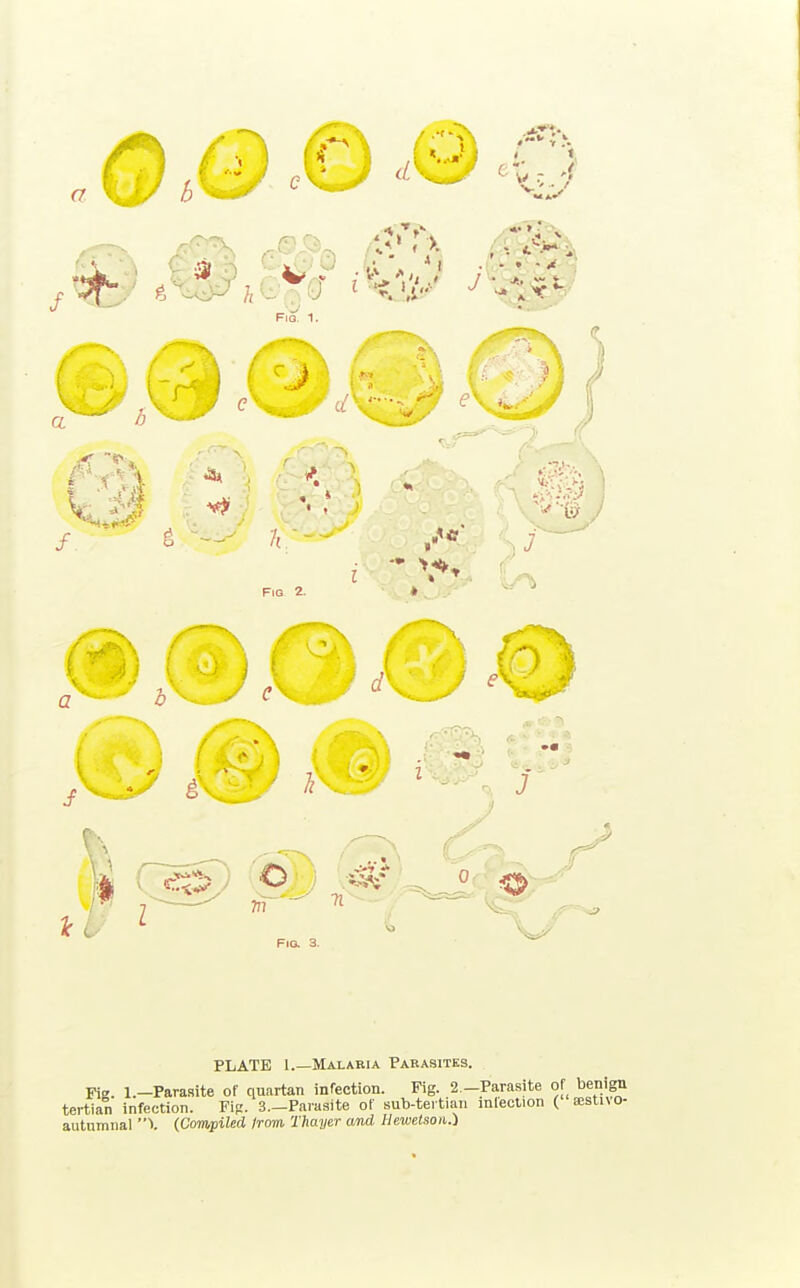 PLATE 1.—Malaria Parasites. Fig. l.-Parasite of quartan infection. Fig. 2.-Parasite of benign tertian infection. Fip. S.-Parasite of sub-tertian infection ( Eestivo- autumnal X (Compiled Irm Thayer and Hewetson.i