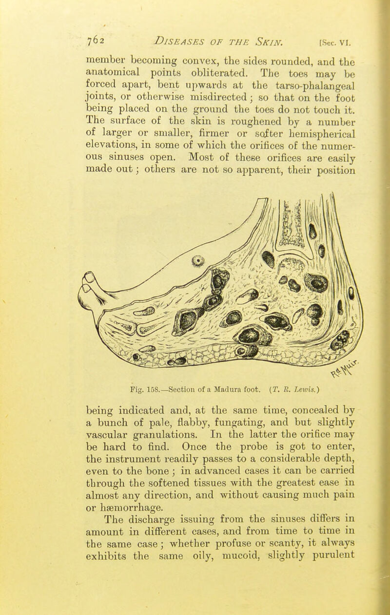 member becoming convex, the sides rounded, and the anatomical points obliterated. The toes may be forced apart, bent upwards at the tarso-phalangeal joints, or otherwise misdirected; so that on the foot being placed on the ground the toes do not touch it. The surface of the skin is roughened by a number of larger or smaller, firmer or softer hemispherical elevations, in some of which the orifices of the numer- ous sinuses open. Most of these orifices are easily made out; others are not so apparent, their position Fig. IDS.—Section of a Madura foot. (T. R. Lewis.) being indicated and, at the same time, concealed by a bunch of pale, flabby, fungating, and but slightly vascular granulations. In the latter the orifice may be hard to find. Once the probe is got to enter, the instrument readily passes to a considerable depth, even to the bone ; in advanced cases it can be carried through the softened tissues with the greatest ease in almost any direction, and without causing much pain or haemorrhage. The discharge issuing from the sinuses differs in amount in different cases, and from time to time in the same case; whether profuse or scanty, it always exhibits the same oily, mucoid, slightly purulent