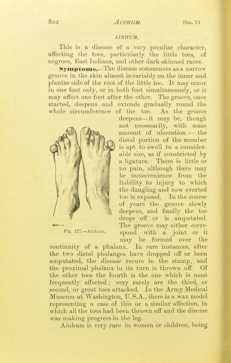 AINIIUM. This is a disease of a very peculiar character, affecting the toes, particularly the little toes, of negroes, East Indians, and other dark-skinned races. Syiii|>toms.--The disease commences as a narrow groove in the skin almost invariably on the inner and plantar side of the root of the little toe. It may occur in one foot only, or in both feet simultaneously, or it may affect one foot after the other. The groove, once started, deepens and extends gradually round the whole circumference of the toe. As the groove The groove may either corre- Fig. 177.-Amhum. spond with a joint or it may be formed over the continuity of a phalanx. In rare instances, after the two distal phalanges have dropped off or been amputated, the disease recurs in the stump, and the proximal phalanx in its turn is thrown off. Of the other toes the fourth is the one which is most frequently affected; very rarely are the third, or second, or great toes attacked. In the Army Medical Museum at Washington, U.S.A., there is a wax model representing a case of this or a similar affection, in which all the toes had been thrown off and the disease was making progress in the leg. Ainhum is very rare in women or childi'en, being deepens—it may be, though not necessarily, with some amount of ulceration — the distal portion of the member is apt to swell to a consider- able size, as if constricted by a ligature. There is little or no pain, although there may be inconvenience from the liability to injury to which the dangling and now everted toe is exjaosed. In the course of years the groove slowly deepens, and finally the toe drops off or is amputated.