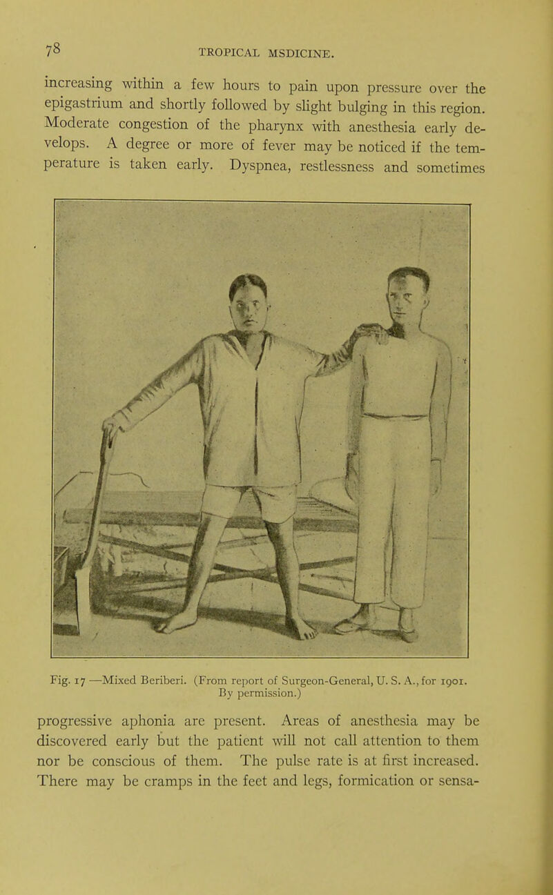 increasing within a few hours to pain upon pressure over the epigastrium and shortly followed by slight bulging in this region. Moderate congestion of the pharynx with anesthesia early de- velops. A degree or more of fever may be noticed if the tem- perature is taken early. Dyspnea, restlessness and sometimes Fig. 17 —Mixed Beriberi. (From report of Surgeon-General, U. S. A., for 1901. By permission.) progressive aphonia are present. Areas of anesthesia may be discovered early but the patient will not call attention to them nor be conscious of them. The pulse rate is at first increased. There may be cramps in the feet and legs, formication or sensa-