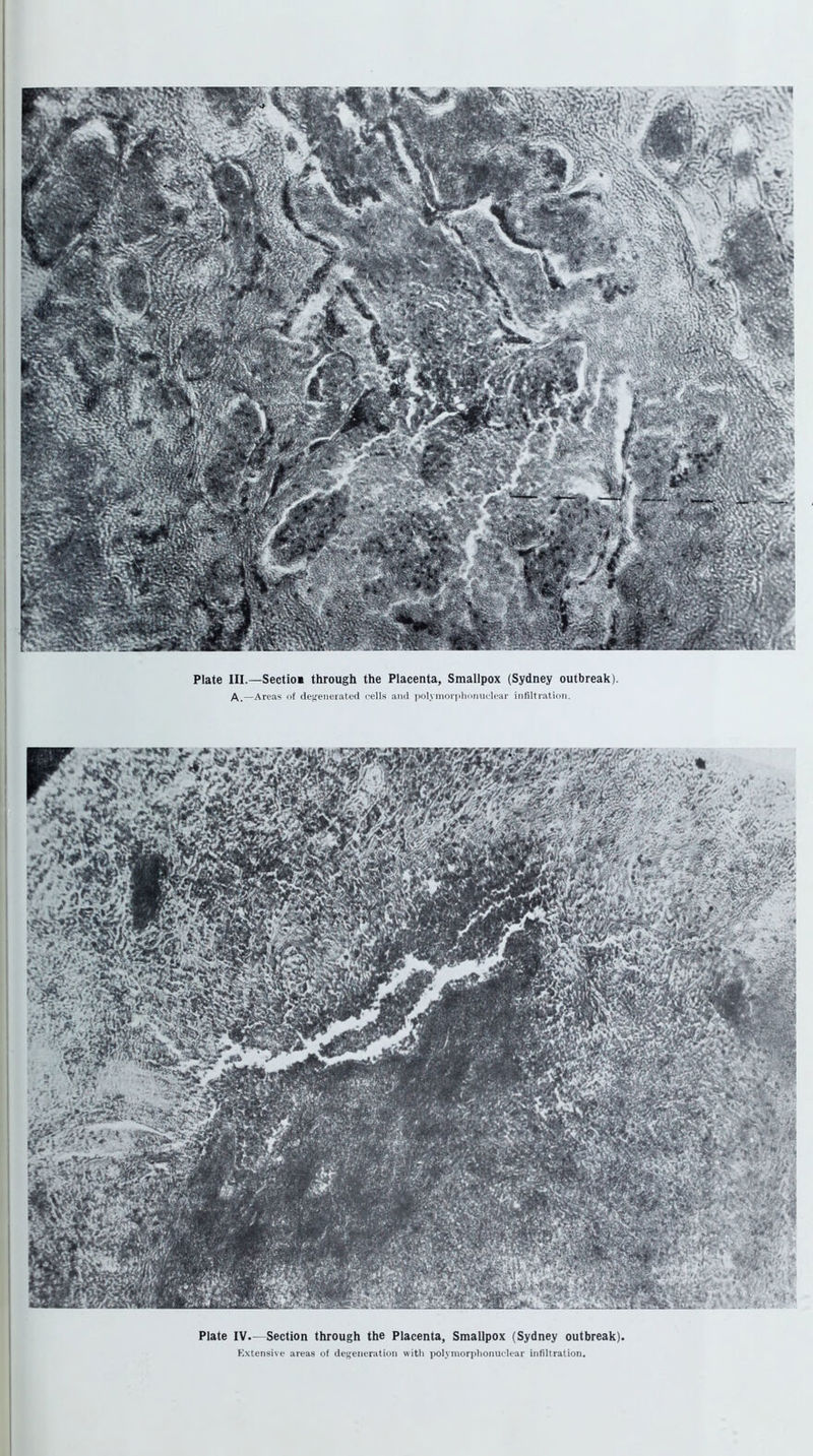 Plate IV.—Section through the Placenta, Smallpox (Sydney outbreak). Extensive areas of degeneration with polymorphonuclear infiltration.