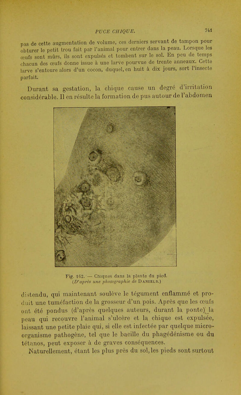 pas de cette augmentation de volume, ces derniers servant de tampon pour obturer le petit trou fait par l'animal pour entrer dans la peau. Lorsque les œufs sont mûrs, ils sont expulsés et tombent sur le sol. En peu de temps chacun des œufs donne issue à une larve pourvue de trente anneaux. Cette larve s'entoure alors d'un cocon, duquel, en huit à dix jours, sort l'insecte parfait. Durant sa gestation, la chique cause un degré d'irritation considérable. Il en résulte la formation de pus autour de l'abdomen Fig. 162. — Chiques dans la plante du pied. (D'après une photographie de Daniels.) distendu, qui maintenant soulève le tégument enflammé et pro- duit une tuméfaction de la grosseur d'un pois. Après que les œufs ont été pondus (d'après quelques auteurs, durant la ponte)Ma peau qui recouvre l'animal s'ulcère et la chique est expulsée, laissant une petite plaie qui, si elle est infectée par quelque micro- organisme pathogène, tel que le bacille du phagédénisme ou du tétanos, peut exposer à de graves conséquences. Naturellement, étant les plus près du sol, les pieds sont surtout