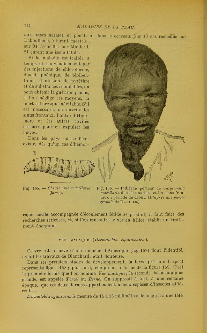aux îosses nasales, et pénètrent dans le cerveau. Sur 13 cas recueillis par Laboulbène, 9 furent mortels ; sur 31 recueillis par Maillard, 21 eurent une issue fatale. Si la maladie est traitée à temps et convenablement par des injections de chloroforme, d'acide phénique, de térében- thine, d'infusion de pyrèthre et de substances semblables, on peut obtenir la guérison ; mais, si l'on néglige ces moyens, la mort est presque inévitable. S'il est nécessaire, on ouvrira les sinus frontaux, l'antre d'High- more et les autres cavités osseuses pour en expulser les larves. Dans les pays où ce fléau existe, dès qu'un cas d'hémor- Fig. 165. Chrysomyia macellaria (larve). Fig. 166. — Indigène porteur de Chrysomyia macellaria dans les narines et les sinus fron- taux ; période de début. {Diaprés une photo- graphie de Daniels.) ragie nasale accompagnée d'écoulement fétide se produit, il faut faire des recherches sérieuses, et, si l'on rencontre le ver en hélice, établir un traite- ment énergique. VER MACAQUE {Dermatobiu cijaniventris). Ce ver est la larve d'une mouche d'Amérique (fig. 167) dont l'identité, avant les travaux de Blanchard, était douteuse. Dans ses premiers stades de développement, la larve présente l'aspect représenté figure 168 ; plus tard, elle prend la forme de la figure 169. C'est la première forme que l'on nomme Ver macaque; la seconde, beaucoup plus grande, est appelée Torcel ou Berne. On supposait à tort, à une certaine époque, que ces deux formes appartenaient à deux espèces d'insectes diffé- rentes. Dermatobia cyaniventris mesure de 14 à 16 millimètres de long ; il a une tête