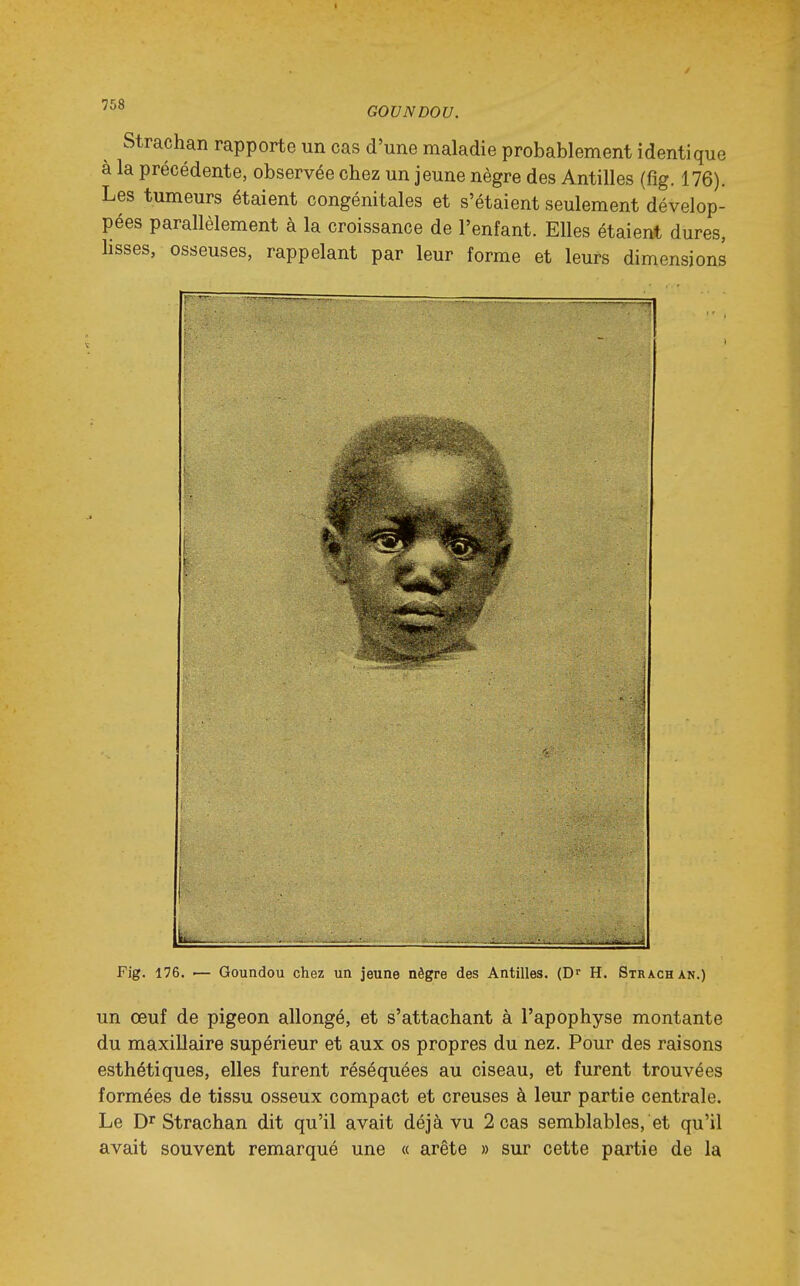 GOVNDOU. Strachan rapporte un cas d'une maladie probablement identique à la précédente, observée chez un jeune nègre des Antilles (fig. 176). Les tumeurs étaient congénitales et s'étaient seulement dévelop- pées parallèlement à la croissance de l'enfant. Elles étaient dures, lisses, osseuses, rappelant par leur forme et leurs dimensions Fig. 176. ■— Goundou chez un jeune nègre des Antilles. (D^ H. Strachan.) un œuf de pigeon allongé, et s'attachant à l'apophyse montante du maxillaire supérieur et aux os propres du nez. Pour des raisons esthétiques, elles furent réséquées au ciseau, et furent trouvées formées de tissu osseux compact et creuses à leur partie centrale. Le Dr Strachan dit qu'il avait déjà vu 2 cas semblables, et qu'il avait souvent remarqué une « arête » sur cette partie de la