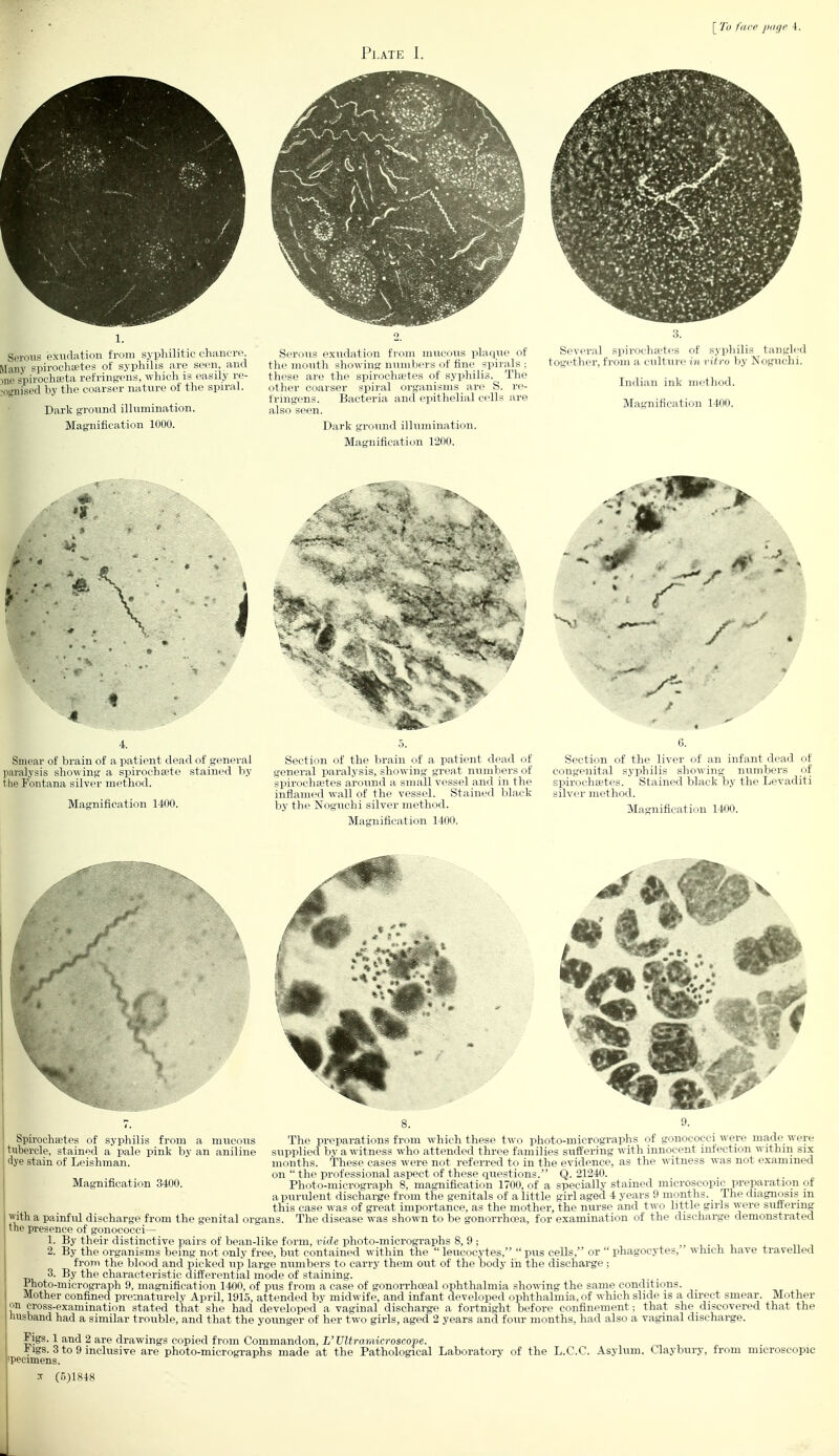 Serous exudation from syphilitic chancre Many spirochsetes of syphilis are seen, and  • _i. i„;—„v,c -..tTiJ^.v. onailv VP- Dark ground illumination. Magnification 1000. ■ • r tiie Fontana silver method. Magnification 1400. Section of the bram of a patient dead of general paralysis, showing great numbers ot spirochaetes around a small vessel and m the .i^n__ _ . stained black Section of the liver of an infant dead of congenital syphilis showing numbers of spirochsetes. Stained black by the Levaditi silver method. Magnification 1400. ■nification 3400. The preparations from which these two photo-micrographs of gonococci were made were supplied bv a witness who attended three families suffering with innocent infection withm six months. These cases were not referred to in the evidence, as the witness was not examined on  the professional aspect of these questions. Q. 21240. Photo-micrograph 8, magnification 1700, of a specially stained microscopic preparation of apurulent discharge from the genitals of a little girl aged 4 years 9 months^ The chagnosis m this case was of great importance, as the mother, the nurse as. The disease -n ' with a painful discharge from the genital the presence of gonococci— 1. By their distinctive pairs of bean-like form, vide photo-micrographs 8, 9 ; 2. By the organisms being not only free, but contained within the  leucocytes,  pus cells, or  phagocytes, from the blood and picked up large numbers to carry them out of the body in the discharge ; 3. By the characteristic differential mode of staining. JPnoto-micrograph 9, magnification 1400, of pus from a case of gonorrhoeal ophthalmia showing the same condit Mother confined prematurely April, 1915, attended by midwife, and infant developed ophthali ' -^--^ cross-examination stated that she had developed a vaginal discharge  husband had a similar trouble, and that the younger of her two girls, aged 2 Figs. 1 and 2 are drawings copied from Commandon, L'Ultramicroscope. p^^^^s. 3 to 9 inclusive are photo-microgi-aphs made at the Pathological Laboratory of the L.C.C. Asyluj which have travelled ^. c.^i^c^i of which slide is a direct smear. Mother fortnight before confinement; that she discovered that the years and four months, had also a vaginal discharge.