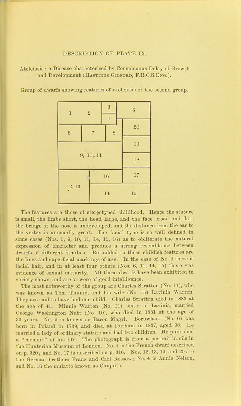 DESCRIPTION OF PLATE IX. Ateleiosis: a Disease characterised by Conspicuous Delay of Growth and Development (Hastings G-ilpobd, P.R.C.S.Eng.). Group of dwarfs showing features of ateleiosis of the second group. 1 2 3 5 4 20 6 7 8 19 9, 10,. 11 18 12,13 * 16 17 14 15 The features are those of stereotyped childhood. Hence the stature is small, the limbs short, the head large, and the face broad and flat; the bridge of the nose is undeveloped, and the distance from the ear to the vertex is unusually great. The facial type is so well defined in some cases (Nos. 5, 9, 10, 11, 14, 15, 16) as to obliterate the natural expression of character and produce a strong resemblance between dwarfs of different families But added to these childish featiu-es are the lines and superficial markings of age. In the case of No. 9 there is facial hair, and in at least four others (Nos. 6, 11, 14, 15) there was evidence of sexual matiu-ity. All these dwarfs have been exhibited in variety shows, and are or were of good intelligence. The most noteworthy of the group are Charles Stratton (No. 14), who was known as Tom Thumb, and his wife (No. 15) Lavinia Warren. They are said to have had one child. Charles Stratton died in 1883 at the age of 41. Minnie Warren (No. 11), sister of Lavinia, married George Washington Nutt (No 10), who died in 1881 at the age of 33 years. No. 9 is known as Baron Magri. Boruwlaski (No. 6) was bom in Poland in 1739, and died at Durham in 1837, aged 98. He married a lady of ordinary stature and had two children. He published a memoir of his life. The photograph is from a portrait in oils in the Hunterian Museum of London. No. 4 is the Trench dwarf described on p. 320; and No. 17 is described on p. 316. Nos. 12, 13, 19, and 20 are the German brothers Eranz and Carl Eossow; No. 4 is Annie Nelson, and No. 16 the mulatto known as Chiquita.
