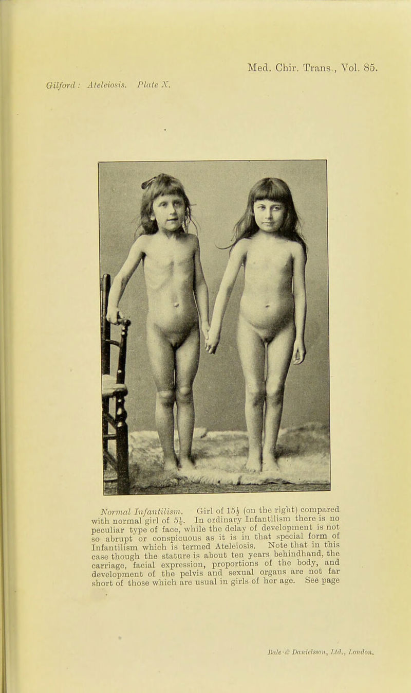 Gilford : Atekionis. Plate X. Med. Ghir. Trans., Vol. 85. Normal Injanldisiii. (lirl of 15* (on the rigiit) compared with normal girl of 5i. In ordinary Infantilism there is no peculiar type of face,'while the delay of development is not so abrupt or conspicuous as it is in that special form of Infantilism which is termed Ateleiosis. Note that in this case though the stature is about ten years behuidhand, the carriage, facial expression, proportions of the body, and development of the pelvis and sexual organs are not far short of those which arc usual in girls of her age. See page Jtiile-<C' Daiiirlsmii, I,Id., I.ntuln)i.