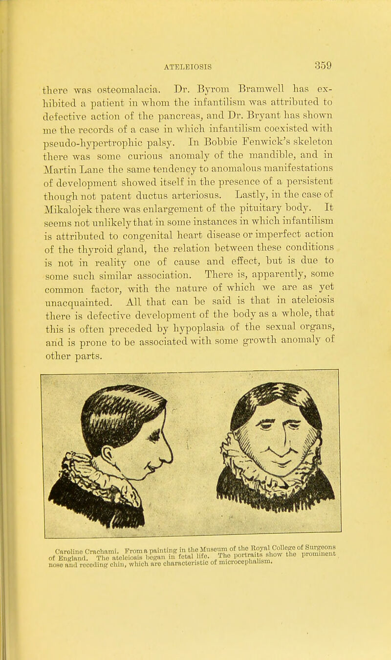 there was osteomalacia. Dr. Byrom Bramwell has ex- hibited a patient in whom the infantilism was attribnted to defective action of the pancreas^ and Dr. Bryant has shown me the records of a case in which infantilism coexisted with pseudo-hypertrophic palsy. In Bobbie Fenwick's skeleton there was some curious anomaly of the mandible, and in Martin Lane the same tendency to anomalous manifestations of development showed itself in the presence of a persistent though not patent ductus arteriosus. Lastly, in the case of Mikalojek there Avas enlargement of the pituitary body. It seems not unlikely that in some instances in which infantilism is attributed to congenital heart disease or imperfect action of the thyroid gland, the relation between these conditions is not in reality one of cause and effect, but is due to some such similar association. There is, apparently, some common factor, with the nature of which we are as yet unacquainted. All that can be said is that in ateleiosis there is defective development of the body as a whole, that this is often preceded by hypoplasia of the sexual organs, and is prone to be associated with some growth anomaly of other parts. nose and receding chin, which are charactonstic of microcephahsra.