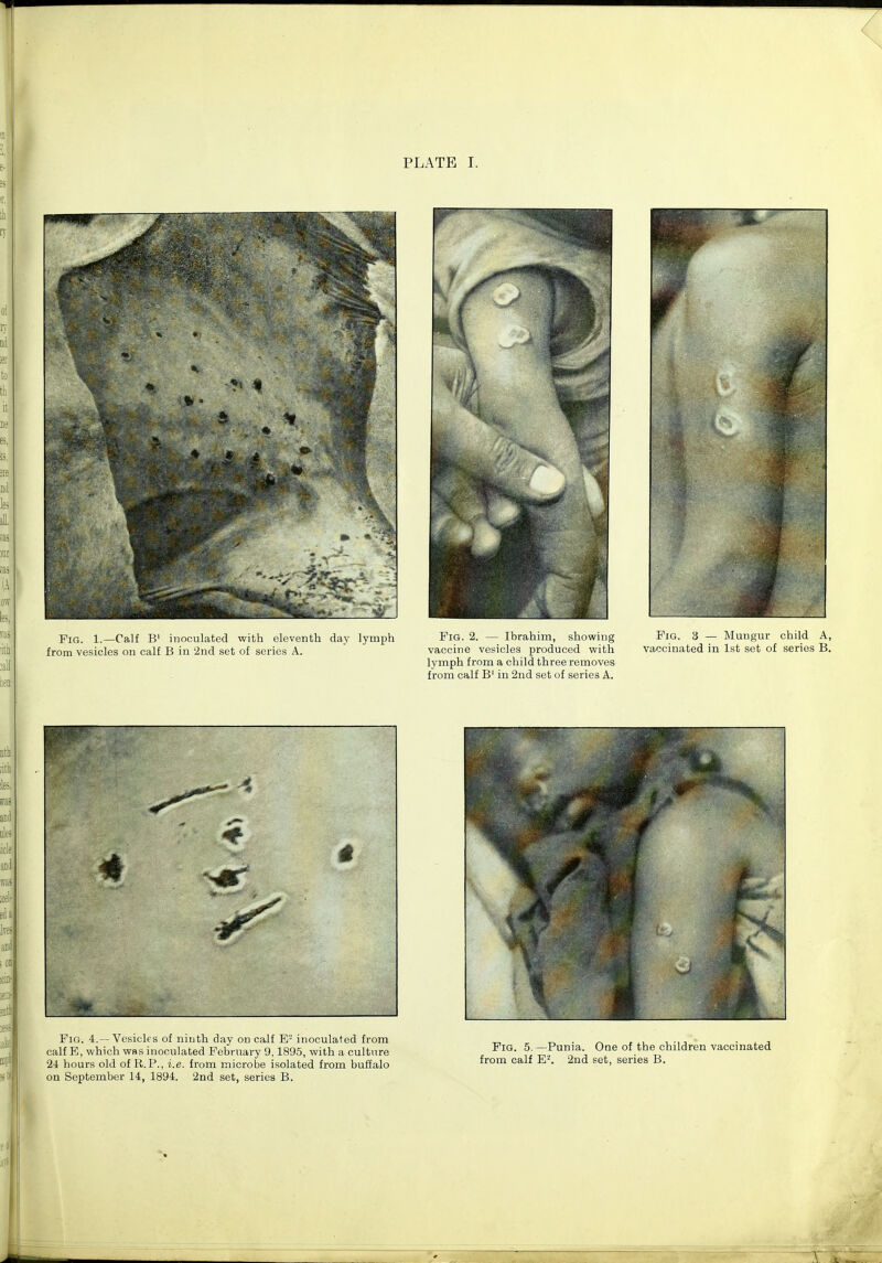 Fig. 1.—Calf B' inoculated with eleventh day lymph Fig. 2. — Ibrahim, showing Fig. 3 — Mungur ch from vesicles on calf B in 2nd set of series A. vaccine vesicles produced with vaccinated in 1st set of se: lymph from a child three removes from calf B' in 2nd set of series A.