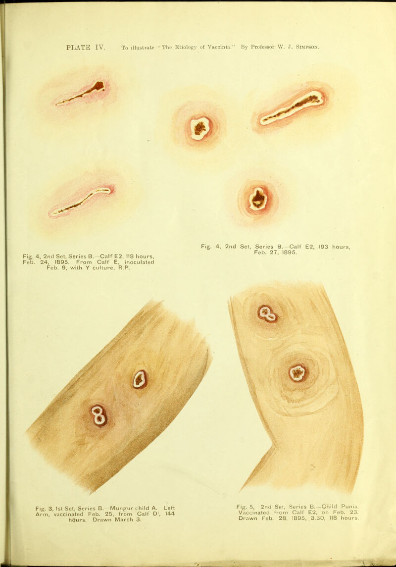 PLATE IV. To illustrate The Etiology of Vaccinia. By Professor W. J. Simpson. Fig. 4-, 2nd Set, Series B.—Calf E2, 193 hours, Feb. 27, 1895. Fig. 4, 2nd Set, Series B.—Calf E2, 118 hours, Feb. 24, 1895. Fronn Calf E, inoculated Feb. 9, with Y culture, R.P. Fig. 3, 1st Set, Series B.- Mungur child A. Left Arm, vaccinated Feb. 25, from Calf D', 144 hOwrs. Drawn March 3. Fig. 5, 2nd Set, Series B. -Child Punia. Vaccinated from Calf E2, on Feb. 23. Drawn Feb. 28. 1895, 3.30, 118 hours.