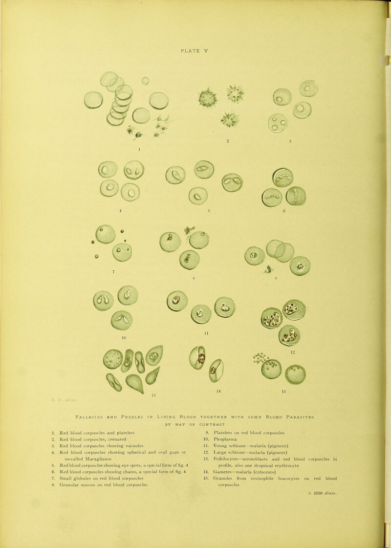 PLATE V S.. D, Mdir Fallacies and Puzzles in Living Blood together with some Blood Parasites BY WAY OF contrast 1. Red blood corpuscles and platelets 9. Platelets on red blood corpuscles ■ 2. Red blood corpuscles, crenated 10. Piroplasma 3. Red blood corpuscles showing vacuoles 11. Young schizont—malaria (pigment) 4. Red blood corpuscles showing spherical and oval gaps or 12. Large schizont—malaria (pigment) so-called Maraglianos 13. Poikilocj'tes—normoblasts and red blood corpuscles in S. Red blood corpuscles showing eye spots, a special form of fig. 4 profile, also one dropsical erythrocyte 6. Red blood corpuscles showing chains, a special form of fig. 4 14. Gametes—malaria (crescents) 7. Small globules on red blood corpuscles 15. Granules from eosinophile leucocytes on red blood 8. Granular masses on red blood corpuscles corpuscles X 1000 i/ia»f.