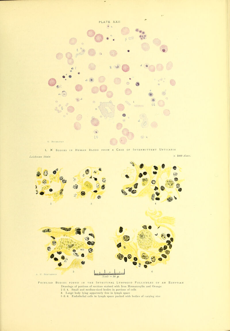 PLATE XXII :* h ^^*) © i\ * ^1 G. BOCHANAtJ 1. X Bodies in Human Blood from a Case of Intermittent Urticaria Lcisliiiian Stain 6 Si X 1000 Sea A' ^ 30 Peculiar Bodies found in the Intestinal Lymphoid Follicules of an Egyptian Drawings of portions of sections stained with Iron Hcematoxylin and Orange 2 & 4. Small and medium-sized bodies in portions of cells 3. Large body lying apparently' free in lymph space