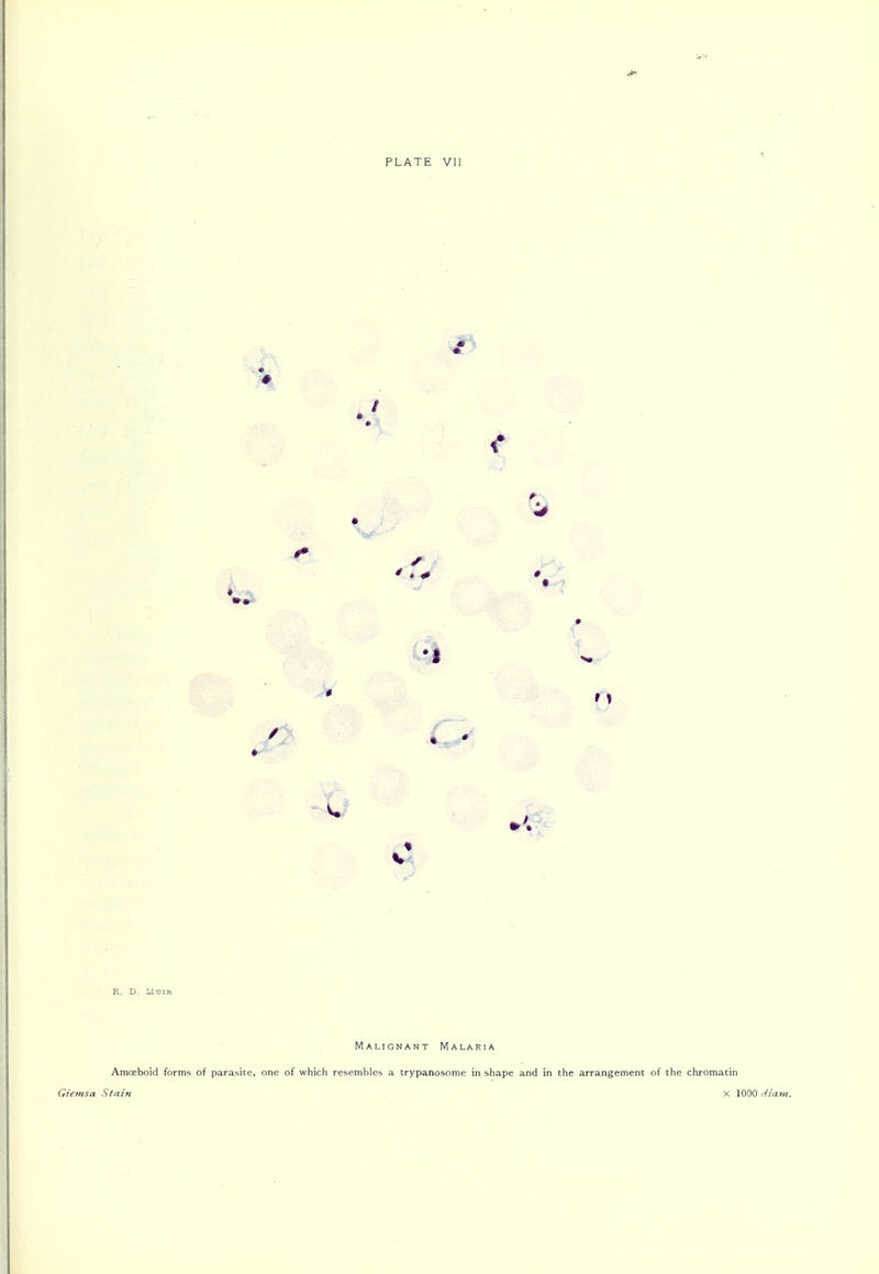 PLATE Vll Si n Malignant Malaria Amoeboid forms of parasite, one of wliich resembles a trypanosome in shape and in the arrangement of the chromatin Gientsa Stain . X 1000 diam.